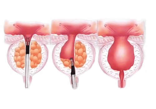 BPH (Enlarged Prostate)