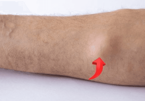 Lipoma