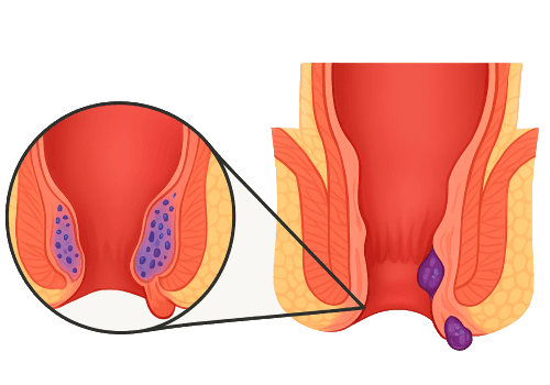 Piles (Hemorrhoids)