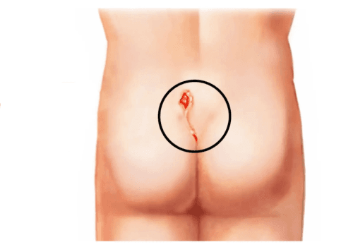 Pilonidal Sinus