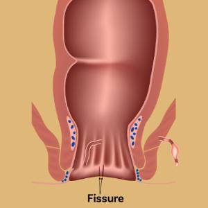 Laser Fissure Treatment Ahmedabad