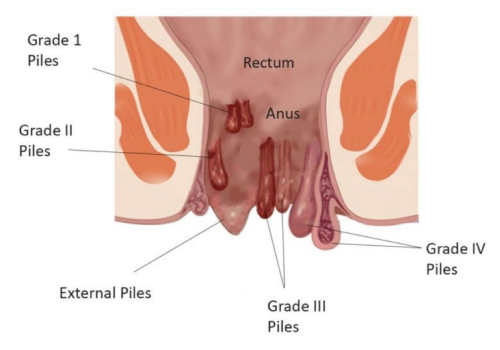 Ano-Rectal Diseases Treatment In Ahmedabad
