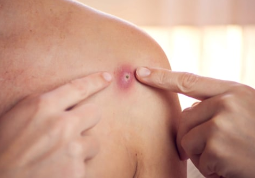 Boils Treatment In Ahmedabad