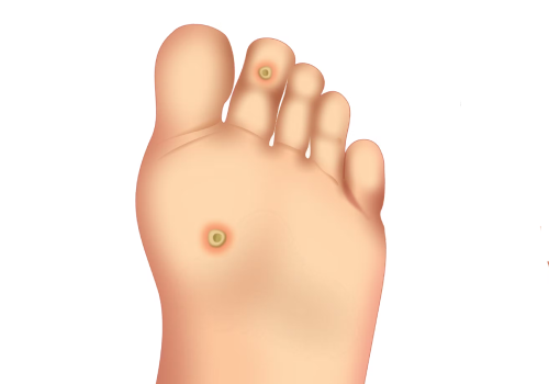 Corn Treatment In Ahmedabad