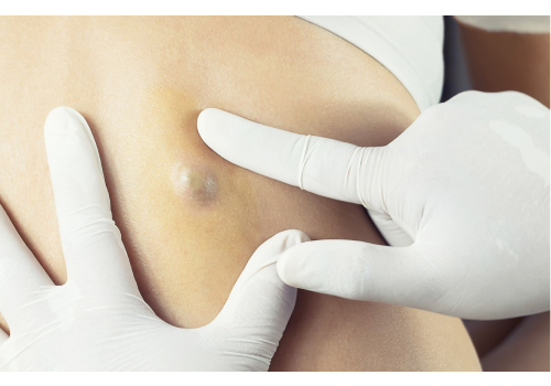 Cyst Treatment In Ahmedabad