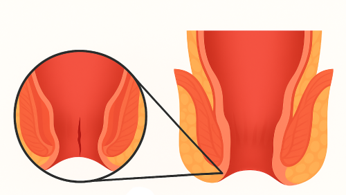 Fissure Treatment In Ahmedabad