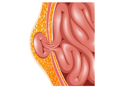  Hernia Treatment in Ahmedabad