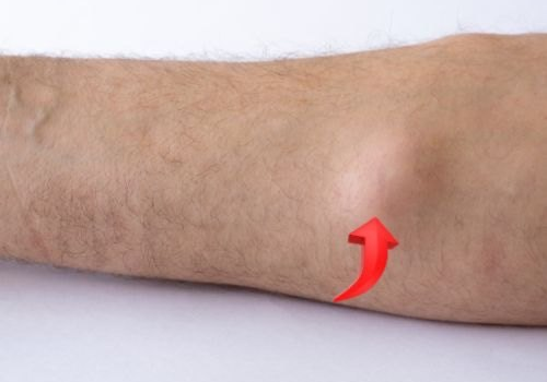 Lipoma Treatment In Ahmedabad