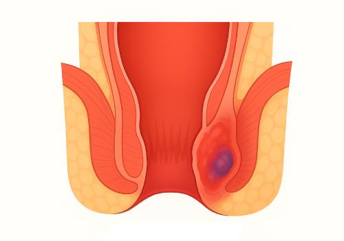 Perianal Treatment In Ahmedabad