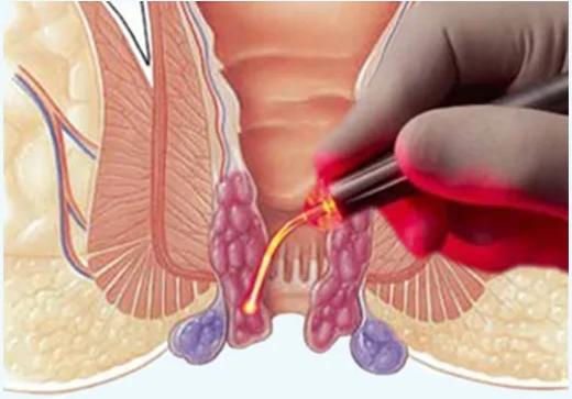 Laser Treatment For Piles in Ahmedabad