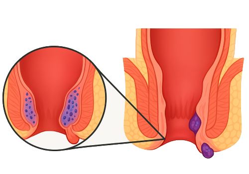 Piles Treatment in Ahmedabad