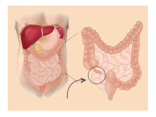 Appendix Treatment in Ahmedabad