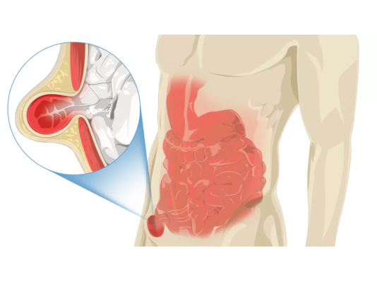Hernia Treatment in Ahmedabad