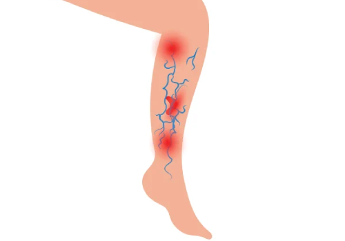 Venous Ulcer Treatment In Ahmedabad