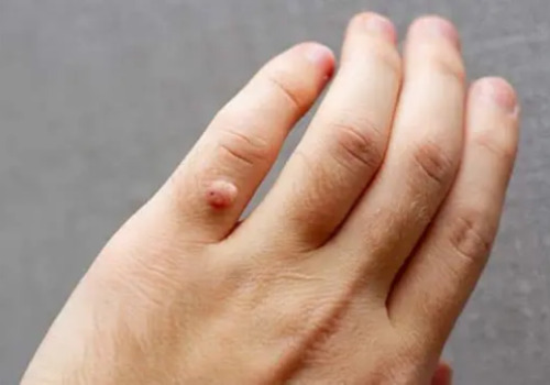 Warts Treatment In Ahmedabad