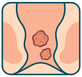 Anal Warts